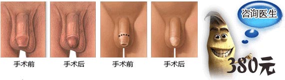 赤峰包皮仅为380元