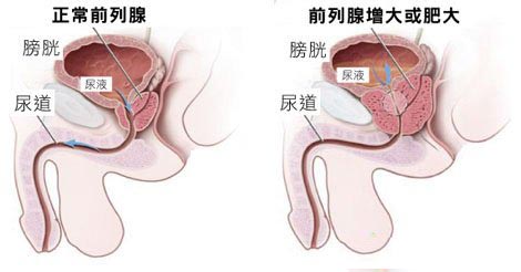 赤峰前列腺