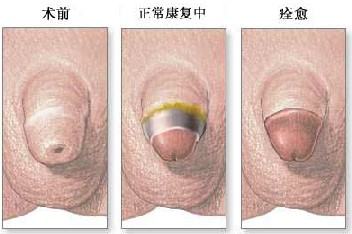 赤峰包皮